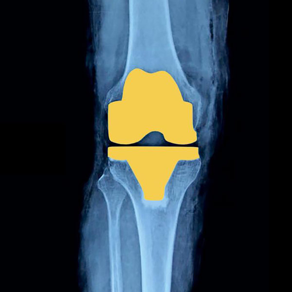 Robotic Knee Replacement Image