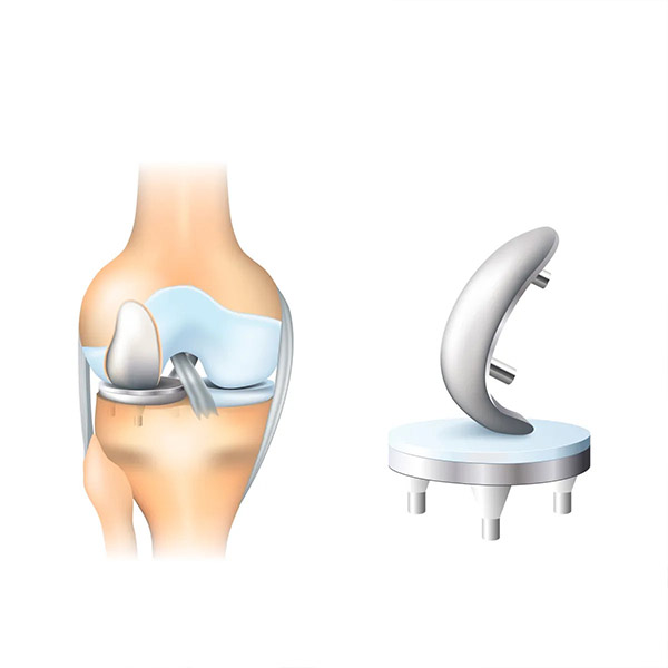 Robotic Partial Knee Replacement Image